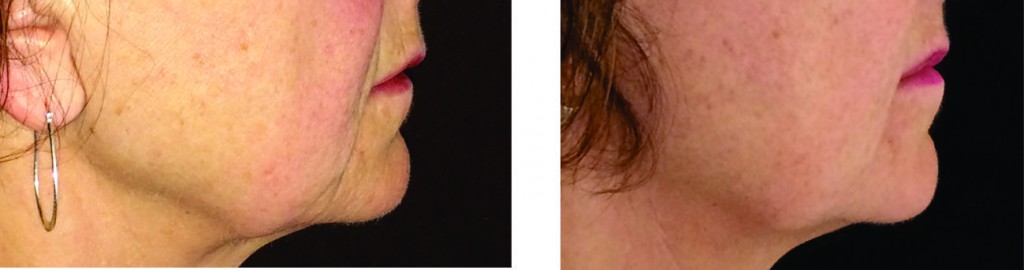 Jaw